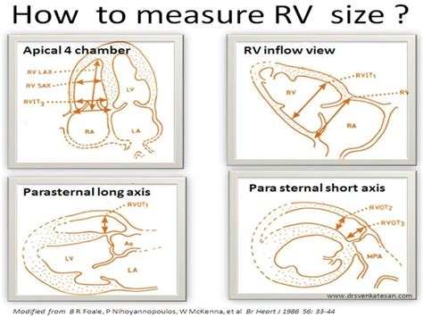 normal rv lv ratio|normal rv wall thickness.